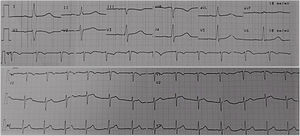 Initial electrocardiogram – 12-lead (above) and rhythm strip (below) initial electrocardiogram.