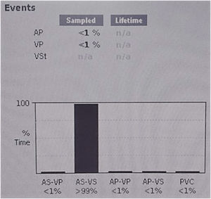 Pacemaker data – Pacemaker data 1 year after dual chamber pacemaker implantation. AP: atrial pacing; AS: atrial sense; VP: ventricular pacing; VS: ventricular sense.