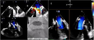 (A and B) Severe mitral prothesis regurgitation due to cusp prolapse, jets directed posterior-laterally and to the left atrial appendage; implantation of an Edwards Sapiens 3 Ultra-29 valve, with transesophageal echocardiography (C) and fluoroscopy (D) guidance; (E) final result: no signs of interference in the adjacent cardiac structures; a small lateral peri-prothesis leak was observed.