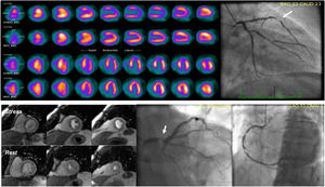 Examples of SPECT and CMR and respective ICA. Top panel – sixty-five-year-old male with anterior and apical ischemia in SPECT; ICA shows a severe stenosis in left anterior descending artery (white arrow). Bottom panel – seventy-nine-year-old male, CMR shows a global defect perfusion, in relation with severe three-vessel ischemia; ICA revealed severe stenosis of left main, and obstructive lesions in right coronary artery.
