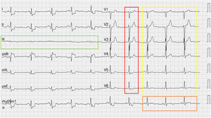 12-lead ECG with pain. Sinus rhythm with ST elevation in aVR and depression in the rest of limb leads. The green rectangle shows lead III without any alteration. Non-specific ST changes can be seen in the precordial leads, indicated by a red rectangle. It is likely that a spontaneous repositioning of the patient's wrist slightly reduced the radial artery-electrode (self-adhesive type electrode) contact with the consequent resolution of the artifact (yellow and orange rectangles). Digitize using PM Cardio.