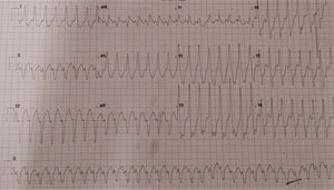 Admission electrocardiogram showing monomorphic ventricular tachycardia with a pattern of left bundle branch block and superior axis.