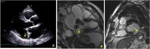 (A) Transthoracic echocardiogram in parasternal long-axis view showing mitral annular disjunction (yellow arrow); (B) cardiac magnetic resonance imaging, 3-chamber cine view, showing mitral annular disjunction (yellow arrow); (C) cardiac magnetic resonance imaging, short-axis view, showing transmural late enhancement in the basal segment of the inferolateral wall.