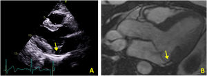 (A) Transthoracic echocardiogram in parasternal long-axis view showing mitral annular disjunction (yellow arrow); (B) cardiac magnetic resonance imaging, 3-chamber cine view, showing mitral annular disjunction at the level of the inferolateral wall (yellow arrow).
