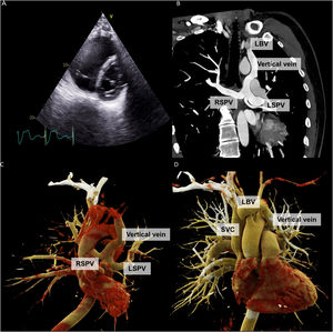 Transthoracic echocardiography parasternal short axis view showing severe dilatation of the right ventricle (panel A). Cardiac computed tomography showing both right and left superior pulmonary veins draining into the left brachiocephalic vein through a vertical vein. An accessory left superior pulmonary vein is observed (panels B and C). Reconstructed three-dimensional cardiac computed tomography imaging showing the vertical vein draining into the left brachiocephalic vein (panel D). LBV: left brachiocephalic vein; LSPV: left superior pulmonary vein; RSPV: right superior pulmonary vein; SVC: superior vena cava.