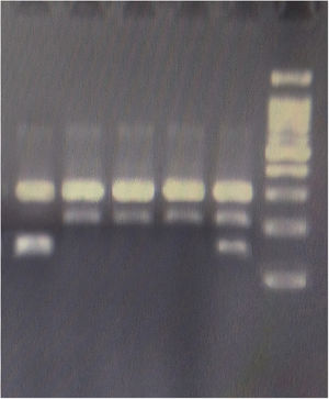 KLF5 rs3812852 genotyping by Tetra Primer ARMS-PCR. The ladder is 100 bp. Pair band of 308 and 219 bp belongs to wild (AA) genotype, pair band of 308 and 146 bp homozygote mutant (GG), three band of 308, 219, and 146 bp heterozygote mutant (AG).