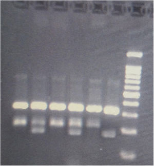KLF7 rs2302870 genotyping by Tetra Primer ARMS-PCR. The ladder is 100 bp. Pair band of 325 and 211 bp belongs to the wild (AA) genotype, pair band of 325 and 169 bp homozygote mutant (GG), three band of 325, 211 and 169 bp heterozygote mutant (AG).
