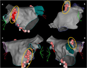 The 3-dimensional representation of the main ganglionated plexus (GP) location. Upper panel: (A) RAGP between the right upper pulmonary vein and the right atrium; (B) RSGP between the superior vena cava and aortic root just above the right upper pulmonary vein; lower panel: (C) RIGP at the roof of the coronary sinus and medial and just under the tricuspid valve and the coronary sinus ostium; (D) LSGP at superolateral area around the root of the left superior pulmonary vein. LSGP: left superior ganglionated plexus; RAGP: right anterior ganglionated plexus; RIGP: right inferior ganglionated plexus; RSGP: right superior ganglionated plexus.