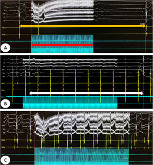 (A) Intracardiac electrogram showing a sinus pause of 7.28 s (orange arrow) induced by vagal stimulation for 4 s (red arrow) before cardioneuroablation. (B) Intracardiac electrogram showing an atrioventricular block (white arrow) induced by vagal stimulation during atrial pacing. (C) Intracardiac electrogram showing abolition of vagal response after cardioneuroablation.