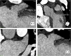 Pre-procedural cardiac computed angiography scan to assess left atrial appendage morphology and dimensions.
