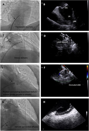 Fluoroscopic images of the intracardiac echocardiography probe (black arrows) and its respective echographic images during a left atrial appendage (LAA) occlusion (LAAO) procedure, showing its utility in guiding transseptal puncture (A and B); device deployment (C and D); assessment of device position, significant peridevice leaks using color Doppler and embolization risk (E and F) and exclusion of pericardial effusion (G and H). IAS: interatrial septum.