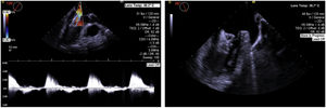 Images of left atrial appendage occlusion (LAAO) device embolization to the left ventricle, attached to the mitral valve apparatus, causing significant mitral regurgitation. This patient underwent urgent cardiac surgery with device removal and surgical LAAO.