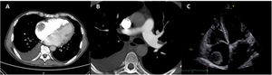 Imaging workup at admission. Computed tomography pulmonary angiography and transthoracic echocardiography images showing right atrial masses (A, C) and thrombi on the left segmental (B) and subsegmental (A) branches of the pulmonary artery.