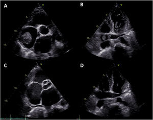 Transthoracic echocardiography four days after admission to the intensive care unit, showing persistence of the right atrial masses with similar dimensions (A) together with mobile thrombi on the coronary sinus (B) and the right pulmonary artery. Seven days after thrombolytic treatment there was complete resolution of the right atrial masses and thrombi on the coronary sinus and right pulmonary artery (C and D).