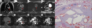 Pericardial hemangioma: MRI – (A) coronal T2-weighted imaging without fat saturation; (B) axial T2-weighted imaging with fat saturation; (C and D) diffusion-weighted imaging with ADC Map; (E–H) dynamic contrast-enhanced imaging – revealing a well-circumscribed mass (arrows) between the pulmonary trunk, the anterior wall of the left ventricle and the aortic root, with no signs of invasion of the surrounding structures; the mass is hyperintense in T2-weighted imaging (A and B), not showing diffusion restriction (C and D); after intravenous administration of gadolinium-based contrast media, the mass presents globular and centripetal enhancement (E–H). A diagnosis of pericardial hemangioma was proposed. Photomicrograph of hematoxylin-and-eosin-stained tissue of the surgical specimen (I) reveals several cavernous spaces filled with blood, corroborating the imaging diagnostic hypothesis of hemangioma.