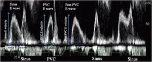 Left ventricular (LV) inflow on echocardiography. During the sinus diastolic phase, the initial LV inflow was defined as “sinus E wave”, and the value obtained by multiplying the maximum sinus E wave velocity and duration was defined as the “sinus E wave flow”. When PVC occurred in the middle of the E wave in the sinus diastolic phase, this E wave was defined as the “PVC E wave”. During the PVC diastolic phase, LV inflow was defined as “post-PVC E wave”. These parameters were calculated as: sinus E wave flow=(sinus E velocity)×(sinus E duration); PVC E wave flow=(PVC E velocity)×(PVC E duration); post-PVC E wave flow=(post-PVC E velocity)×(post-PVC E duration). PVC: premature ventricular contraction.