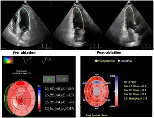 Left ventricular global longitudinal strain (LV-GLS) values measured by strain echocardiography before and after ablation in a typical case.