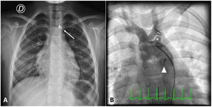 (A) Normal chest X-ray with two vascular clips on the left upper cardiac shadow (arrow); (B) aortic angiography showing the two vascular clips occluding the left subclavian artery 7 mm from its emergence (asterisk). The ductus arteriosus has been occluded with a device (arrowhead).