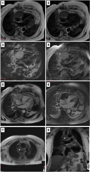Panel exhibiting the cardiac mass characteristics on cardiac magnetic resonance imaging sequences. Image 1: T1 sequence. Image 2: T2 sequence. Image 3: T2 STIR sequence. Image 4: Fat saturation sequences. Image 5: Early enhancement sequence. Image 6: Late enhancement sequences. Images 7 and 8: Exuberant adenopathy conglomerates highlighted with an asterisk.