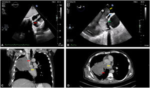 (A) Transthoracic echocardiogram (TTE) with an image suggestive of a cardiac mass with protrusion to the left atrium (LA) (red arrow); (B) TEE with an exuberant tumoral mass in the right inferior pulmonary vein (RIPV) with protrusion of 2.8 cm into the LA (yellow arrow); apparent surgical cleavage plane in the LA (blue arrow); area without surgical cleavage plane (green arrow); lung carcinoma (white arrow); (C) (coronal plane) and (D) (axial plane): chest computed tomography scan showing lung carcinoma (red arrow) invading the LA (yellow arrow).