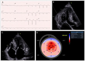 Electrocardiogram and transthoracic echocardiogram. (A) Sinus rhythm, with a heart rate of 78 bpm and poor progression of R waves in precordial leads. (B–D) Small LV cavity (end-diastolic index volume 40 mL/m2) with severe hypertrophy (LV mass index 222 g/m2, septal maximum thickness 22 mm); LV ejection fraction 55–60% and global longitudinal strain −8.9%, exhibiting “apical sparing” (apical/medium-basal ratio of 3.5). Diastolic evaluation: restrictive pattern; E/e′ 20 and tissue velocities <6 cm/s. Left atrium slightly dilated. Right chambers non-dilated and right ventricle (RV) with a reduced systolic function (TAPSE 12 mm, RV S′ 0.12 m/s). Estimated systolic pulmonary arterial pressure was 56 mmHg.
