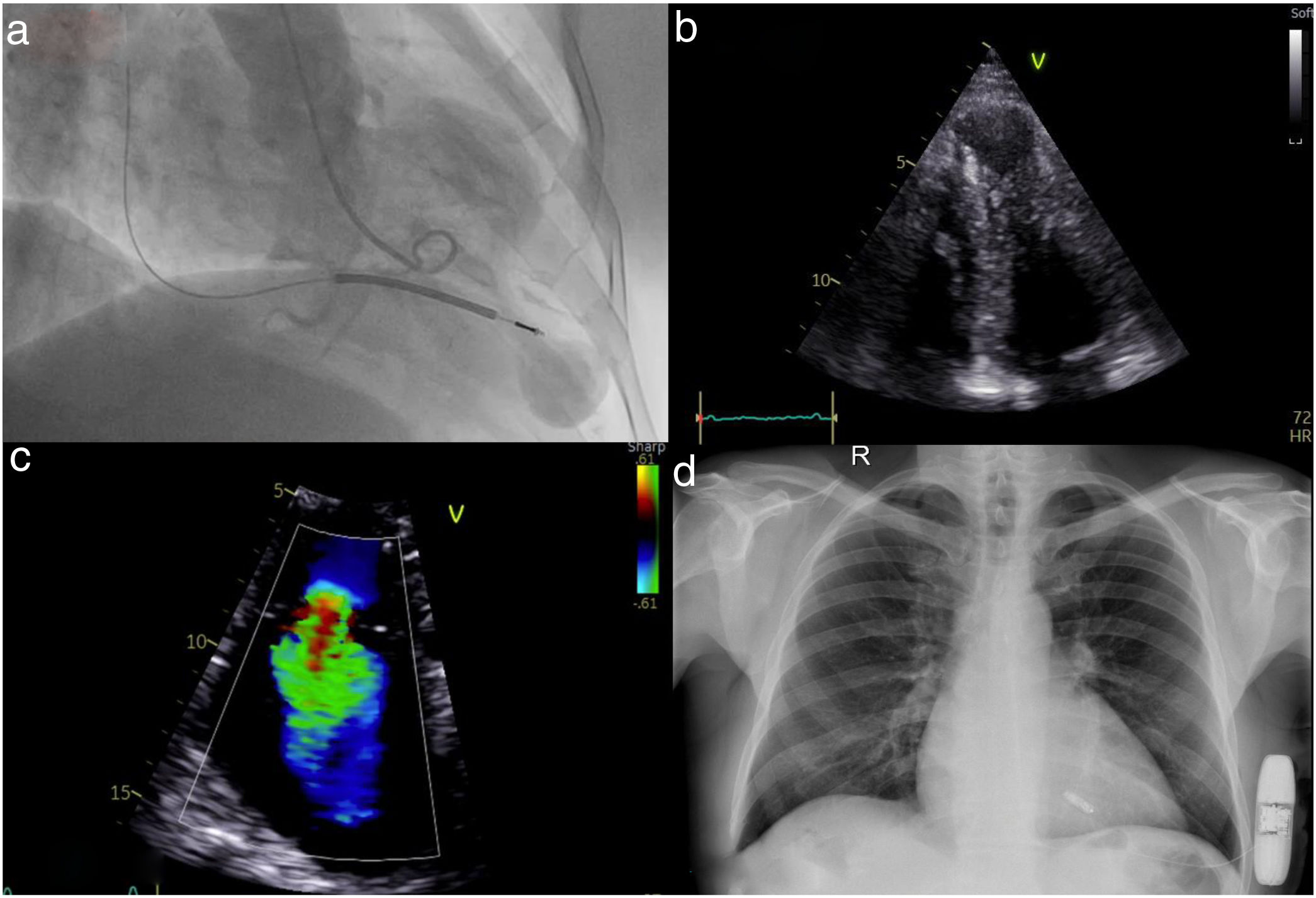 Device therapy and treatment options in a patient with apical ...