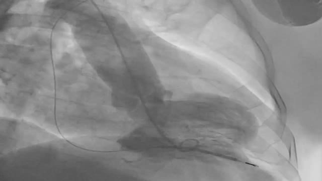 Device therapy and treatment options in a patient with apical ...