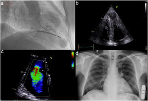 (a) Left ventriculography in systole revealing an apical aneurysm; (b) apical 4-chamber echocardiographic view with hypertrophic left ventricular apical segments and a prominent apical aneurysm; (c) severe tricuspid regurgitation; (d) chest X-ray after implantation of a leadless pacemaker and subcutaneous defibrillator.