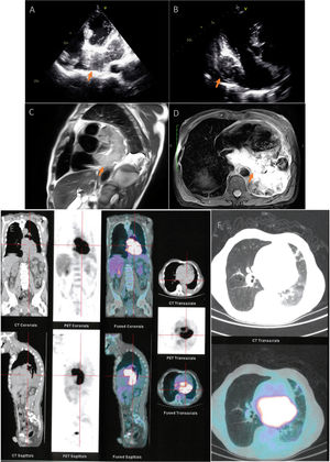 (A) Transthoracic echocardiogram showing cardiac mass involving the left atrium in four-chamber view and (B) in three-chamber view (arrows). (C and D) Cardiac magnetic resonance imaging revealing a posterior mediastinal mass with cardiac infiltration (arrows). (E and F) Positron emission tomography/computed tomography showing a hypermetabolic mass located in the posterior mediastinum.