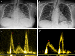 (A and B) Chest radiography during the episode of heart failure after treatment; (C) L wave between rapid left ventricular (LV) filling (E wave) and atrial contraction (A wave); (D) no L wave after decongestion, with impaired LV relaxation pattern (E