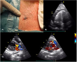 Chest wall lesion (A) and transthoracic echocardiographic images showing a circumferential and large pericardial effusion (B), as well as turbulent flow in aortic root and a severe aortic valve regurgitation (C); fistulous communications between both the right ventricle and left atrium to the aortic root were suspected in the parasternal short axis view (D).