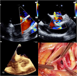 Transesophageal echocardiographic 2D images confirming the injury path (A and B), as well as a 3D image revealing the aortic root fistulas from the right ventricle and to the left atrium (C); intraoperative image of the injured aortic valve, showing aortic cusp laceration (D).