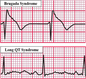 Predisposing factors for arrhythmias associated with OSA. Based on electrocardiographic tracings of Hampton, 2013.43