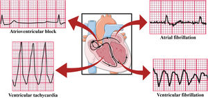 Arrhythmias caused by OSA. Based on electrocardiographic tracings of Hampton, 2013.43