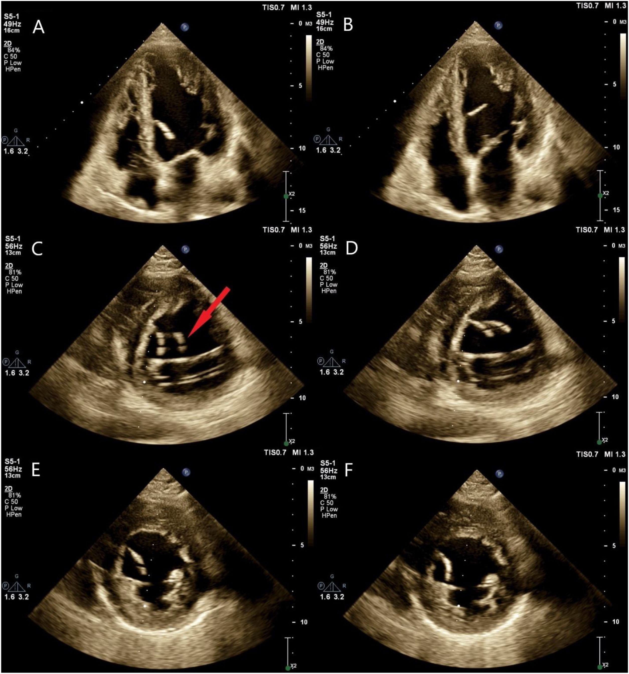 Ghost in the heart: A case of post ischemia left ventricular false ...