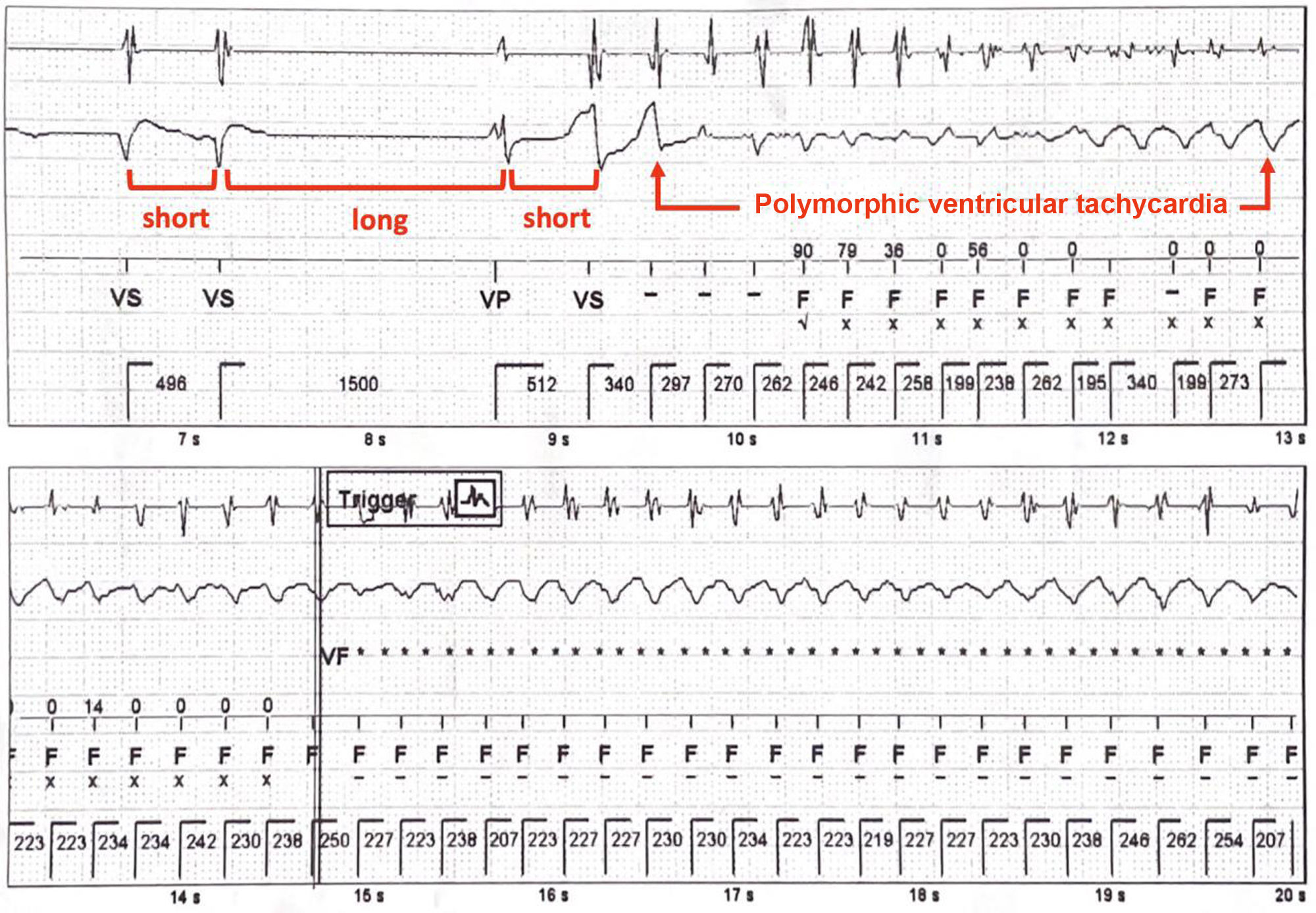 Pacing Pattern Customizing solutions: Ventricular tachycardia and implantable ...