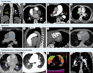 Computed tomography pulmonary angiography findings in chronic thromboembolic pulmonary hypertension. (A) Coronal image showing fibrothrombotic retraction with partial obstruction (yellow arrow) and eccentrically located thrombus with a broad base forming obtuse angles with the vessel wall, due to incomplete thrombus resolution (blue arrow); (B) axial image with intravascular webs (purple arrows); (C) axial image with total left PA occlusion (red arrow) and segmental arterial retraction (orange arrow); (D) calcifications within fibrothrombotic deposits in the right PA, illustrating the chronic component of the disease (green arrows); (E) axial image depicting main PA dilatation (double-headed arrow); (F) sagittal image showing RV outflow tract hypertrophy (double-headed arrow); (G) cardiac short-axis image with flattening of the interventricular septum (black arrows) and D-shaped left ventricle; (H) axial image showing segmental artery-to-bronchus diameter ratio of >1:1 (arrowheads), flattening of the interventricular septum, RV hypertrophy and RV/LV diameter ratio >1 (double-headed arrow); (I) peripheral nodular opacity (brown arrow) in the right upper lobe secondary to previous pulmonary infarction along with intra-arterial fibrothrombotic deposits (blue arrows); (J) axial image showing sharply demarcated segmental and subsegmental areas of hypo- and hyperattenuation (dotted lines); (K) (same patient as in panel J) color maps showing the distribution of perfusion: spectrum from green to red indicates increasing perfusion (hypoperfusion indicated by green areas); (L) sagittal image with bronchial artery hypertrophy (blue arrows). LV: left ventricular; PA: pulmonary artery; RV: right ventricular.
