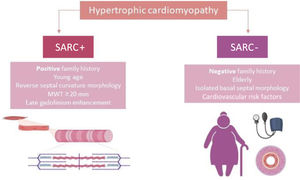 Features of SARC+ and SARC− hypertrophic cardiomyopathy. DCM: dilated cardiomyopathy; MWT: maximum wall thickness; SARC+: sarcomere variant-positive; SARC−: sarcomere variant-negative.