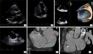 (A) Transthoracic echocardiography (TTE), parasternal long-axis view, showing the mitral valve (red arrow) and the enlarged coronary sinus (white arrow); (B) TTE, 4-chamber view, after injection of saline, without significant opacification; (C) three-dimensional echocardiography showing the coronary sinus (red dot) and left atrium (yellow dot) and revealing the absence of the coronary sinus wall; (D) transesophageal echocardiography showing the patent foramen ovale (green arrow); (E) coronary computed tomography angiography (CCTA) showing the right atrium (blue dot), left atrium (orange dot), the enlarged CS (green dot) with missing roof, communicating directly with the left atrium, and a communication between the right and left atria (purple arrow); (F) CCTA showing the right atrium (blue dot), right ventricle (white dot), left atrium (orange dot) and enlarged coronary sinus (green dot). The aorta (yellow arrow) and pulmonary artery (white arrow) can also be seen.
