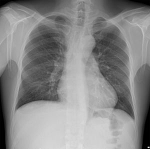 Chest Xray.