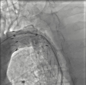 Angiographic resolution with a TEVAR 28 mm.