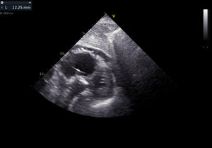 Transthoracic echocardiography showing a circumferential pericardial effusion without hemodynamic impact.