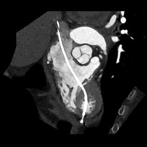 Multiplanar reconstruction computed tomography showing an electrode catheter extending from the inferior vena.