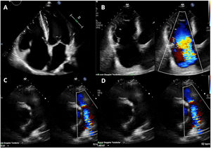 Transthoracic echocardiogram showing: thickening and immobility of the tricuspid leaflets (A) and torrential regurgitation (B and C). Thickening and restriction of the pulmonary valve (D) with moderate regurgitation and mild stenosis (D).