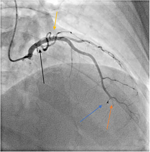 Pre-discharge coronary angiography showing a completely occluded distal left anterior descending artery (LAD) (orange arrow), good angiographic result of the previous ostial LAD stent (yellow arrow), excellent coil retention (blue arrow) in the septal artery, and complete resolution of the thrombosis in the circumflex artery (black arrow).