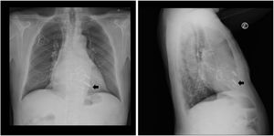 Chest X-ray (postero-anterior and lateral views) post-2nd leadless implantation, showing both leadless devices, previous transvenous lead, the two prosthetic mechanical valves and tricuspid annulus. The arrow identifies the 2nd leadless device.