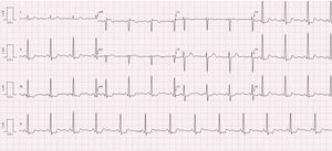 12-Lead ECG of the patient when she was first referred to Cardiology. ECG demonstrated SR with concave-upward ST-segment depression in leads II, III, aVF, V3-6 and ST-segment elevation >0.1 mV in aVR, normal PR (120 milliseconds [ms]) and corrected QT (368 ms) intervals, normal QRS configuration and duration (73 ms).