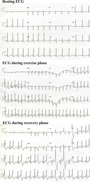 Treadmill exercise stress test with accentuation of preexisting ST-depressions. The preexisting ST-depressions in leads II, III, aVF, V3–V6 showed dynamic accentuation during exercise, returning to basal during recovery phase. The preexisting ST-segment elevation in aVR was also accentuated during exercise. Frequent monomorphic PVCs in the recovery stage were recorded.
