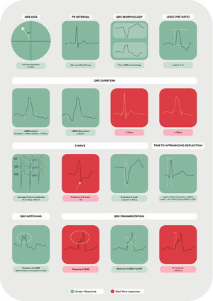 Key electrocardiographic parameters useful in assessing response to cardiac resynchronization therapy.