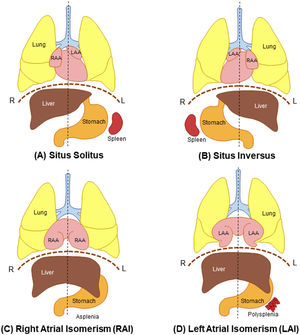 General arrangement of the thoracoabdominal organs in normal individuals and individuals with situs abnormalities, including HTX. (A) Situs solitus is the normal arrangement of the thoracoabdominal organs. (B) Situs inversus is the complete mirror of situs solitus. (C) Right atrial isomerism with bilateral trilobed lungs, bilateral right atrial appendages, central liver, and asplenia. (D) Left atrial isomerism with bilateral bilobed lungs, bilateral left atrial appendages, central liver, and polysplenia. L: left; LAA: left atrial appendage; R: right; RAA: right atrial appendage.